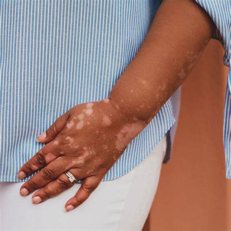 What You Need To Know About Vitiligo As An Autoimmune Disease