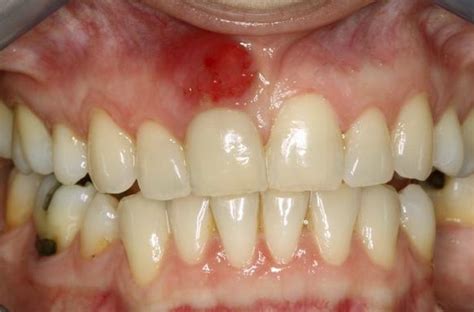 Lump On Gums Pictures Causes Painful Painless Hard Lump