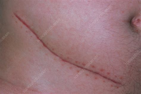 Appendicectomy Scar Stock Image M3320001 Science Photo Library