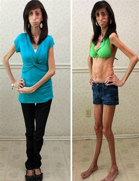 Kamify Blog Meet The Thinnest Girl In The World Woman 24 Weighs 4st