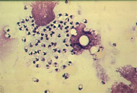 Leishmania Donovani