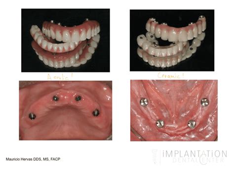 We did not find results for: All-On-4 Dental Implants | Dr. Hervas - Plantation ...
