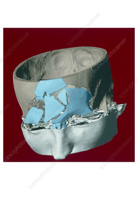 Fractured Skull 3 D Ct Scan Stock Image M3300856 Science Photo