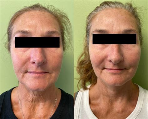 Neck Lift Before And After Photos Patient 318 San Francisco Ca