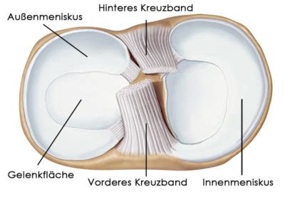 Oft spüren patienten ein knacken im knie oder ein schnappen im kniegelenk. Meniskusriss Ursachen | Symptome | Diagnose | Behandlungen