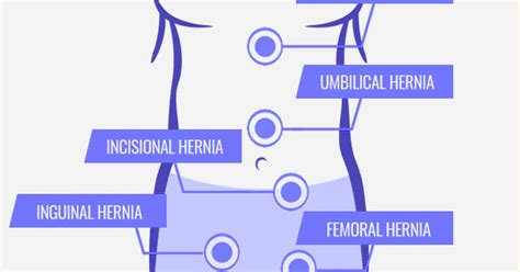 Types Of Hernia