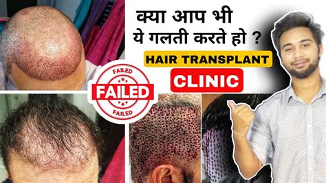 Mistakes You Are Doing While Choosing Hair Transplant Clinic Tips For