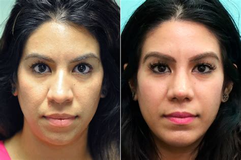 Chin And Facial Implant Rhinoplasty Photos Chevy Chase Md Patient 17613