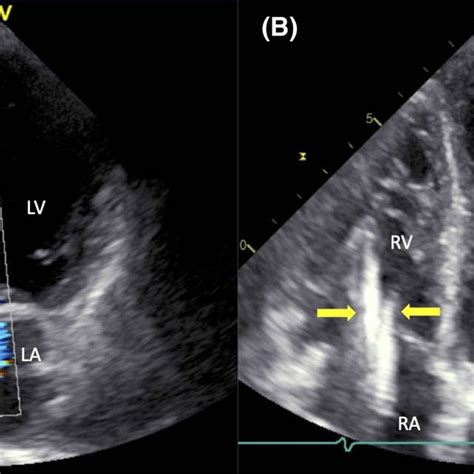 Transthoracic Echocardiography Showing Severe Tricuspid Regurgitation