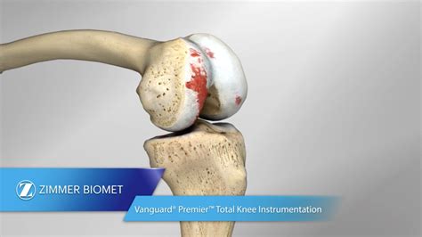 Total Knee Replacement Surgical Technique Zimmer