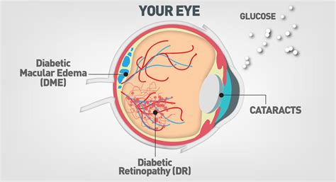 Glucose And The Eye Eye Can Do It