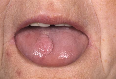 Squamous Papilloma Tongue Icd Virus Papiloma Uomo Wart My XXX Hot Girl
