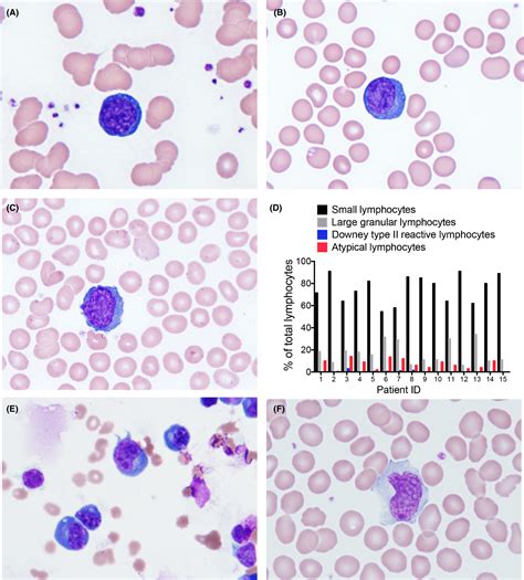 Atypical Lymphocytes Atypical Or Reactive Lymphocytes Are Lymphocytes
