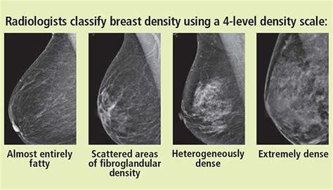 What Does It Mean To Have Dense Breasts Moffitt