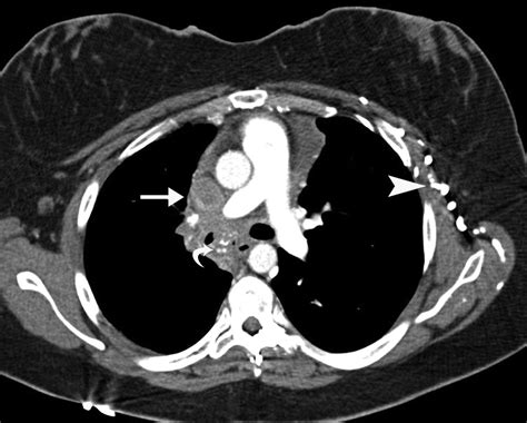 Superior Vena Cava Obstruction Evaluation With Mdct Ajr