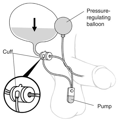 An Artificial Sphincter To Treat Male Urinary Incontinence With Labels