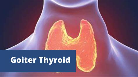 What Is Goiter Thyroid And Know About The Goiter Types