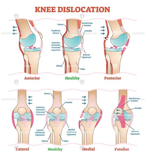 There are many types of knee injuries, and knee pain is the most common indicator of a knee injury. Knee dislocations - medical vector illustration diagrams ...