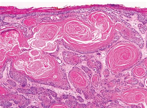 Invasive Squamous Cell Carcinoma Skin Cancer