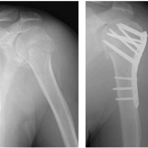 Radiographs Proximal Humeral Fracture Pre And Post Surgery