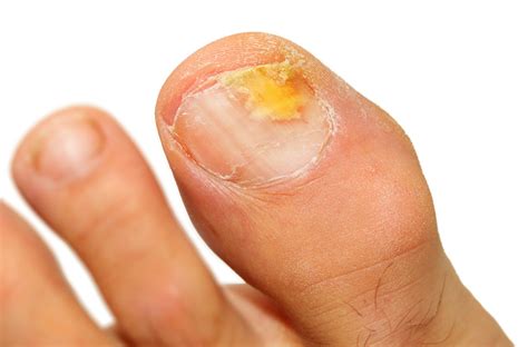 The Way To Treat Foot Fungus Infections In Your Home Active Mind