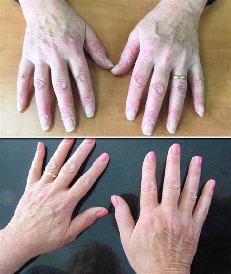 Psoriasis Treatment Update Woman Discovers Miracle Cure In This