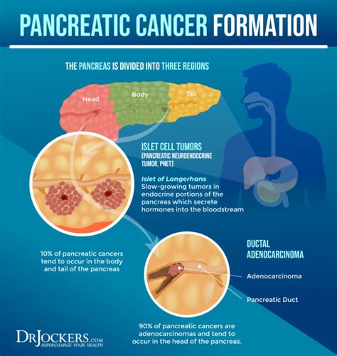 Pancreatic Cancer Symptoms Causes And Support Strategies