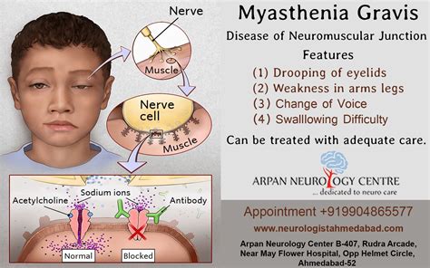 Myasthenia Gravis Mg Is A Neuromuscular Disorder That