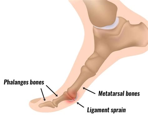 Turf toe describes an injury to the joint at the base of the. Turf Toe Symptoms, Treatment & Taping