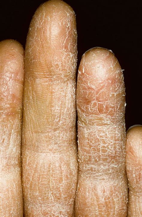 Eczema On The Palms Pictures 224 Photos And Images