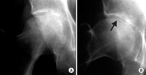 Subchondral Insufficiency Fractures Of The Femoral Head