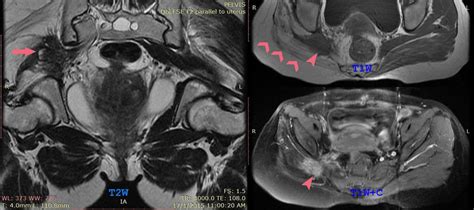 Mri Pelvis Images Showing Right Sciatic Nerve Endometrial Deposit With