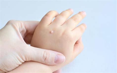 Warts In Children Dr Walias Skin And Laser Clinic