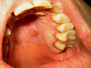 There can be many reasons for having bumps in your mouth. HelloMrDoctor.com