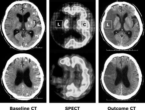 Presence Of Early Ischemic Changes On Computed Tomography Depends On