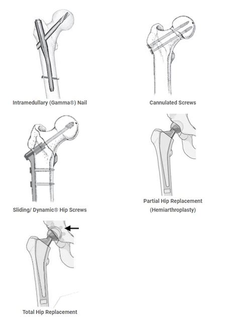 Surgery To Repair A Hip Fracture Learning About