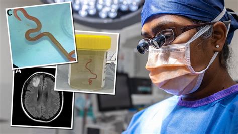 Neurosurgeon Hari Priya Bandi Removes Live Worm From Woman S Brain