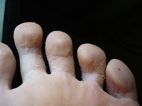 Fungus Between The Fingers Check The Symptoms Choose The Treatment