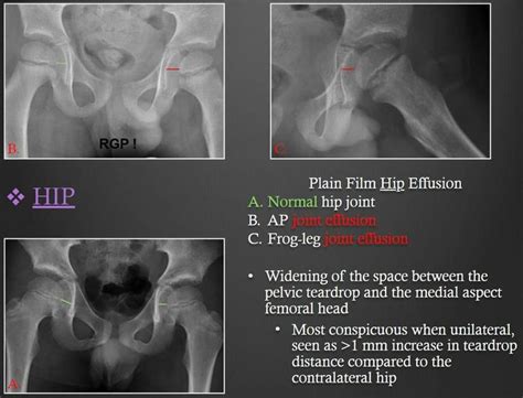 Hip Joint Effusion Joint Pelvis Hips