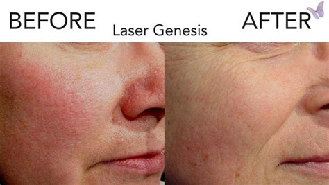 Laser Genesis Skin Rejuvenation Cascades Medspa Orlando Florida