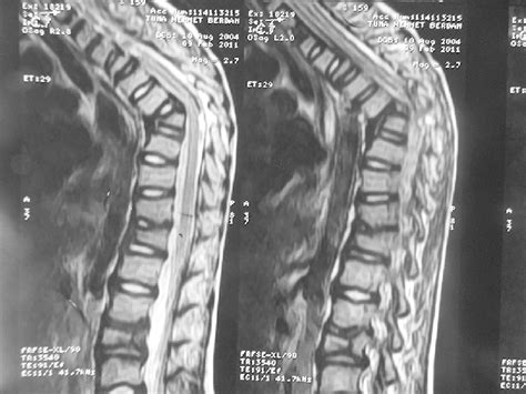 Control Mri Of The Patient Showed Kyphosis At The Level Of T 7‑8