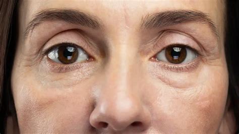 Understanding Hypothyroidism Puffy Eyes Symptoms