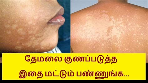 Home Remedies For White Patch Or White Spot On Skin In Tamil Tamil