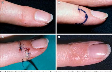 Figure 1 From Skin Excision And Osteophyte Removal Is Not Required In