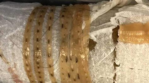 Five Foot Long Tapeworm Came Wiggling Out Of Mans Body After He Ate Sushi Fox News