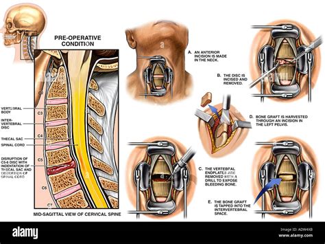 Anterior Cervical Spinal Fusion Surgery