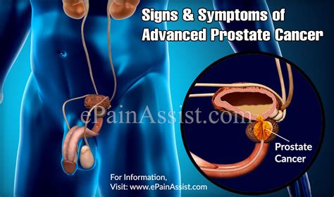 What Were Your First Signs Of Prostate Cancer 4 Early Warning Signs