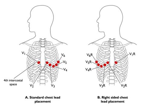 Chest Electrodes