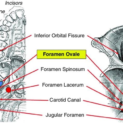 1 Anatomic Landmarks For Foramen Ovale Cannulation Entry Point Green