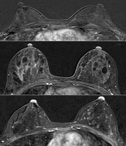 Paget Disease Of The Breast Mammographic Us And Mr Imaging Findings